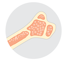 Image of a bone scan, which helps show any abnormal areas of bone growth. 