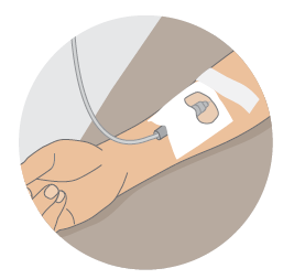 Image of a PET-CT scan, which  is sometimes combined with a CT scan to show the cancer in more detail. A low-dose radioactive glucose solution will be injected into your arm. 