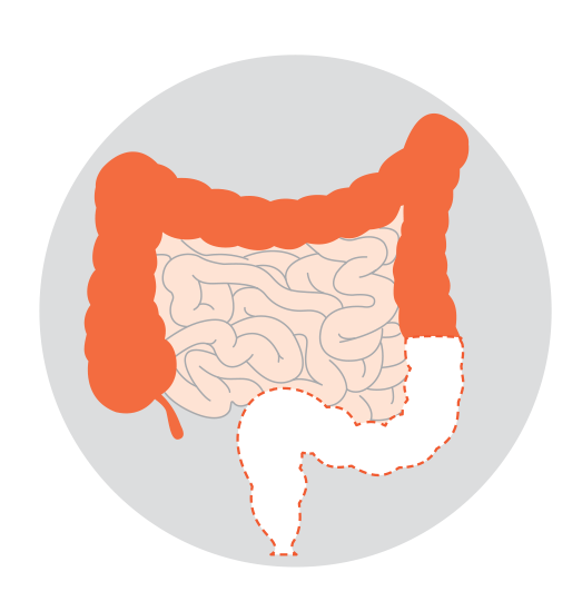 Diagrams showing three types of rectal cancer surgeries: High anterior resection, ultra-low anterior resection and abdominoperineal resection.