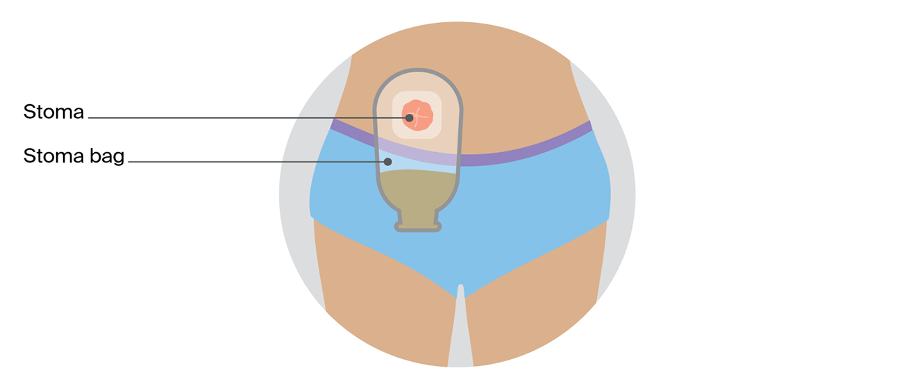 Illustrated diagrams showing types of bowel stomas: a colostomy, an ileostomy and a stoma bag attached to the skin to collect waste.