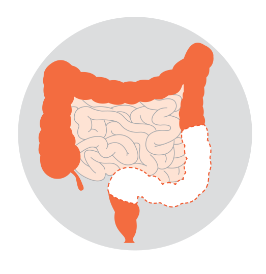 Diagrams showing three types of rectal cancer surgeries: High anterior resection, ultra-low anterior resection and abdominoperineal resection.