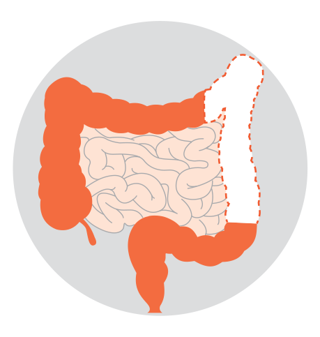 Diagrams showing five types of colectomy: right hemicolectomy, left hemicolectomy, sigmoid colectomy, subtotal or total colectomy and proctocolectomy.