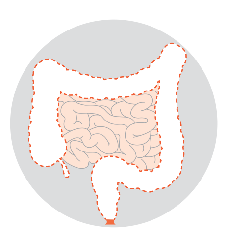 Diagrams showing five types of colectomy: right hemicolectomy, left hemicolectomy, sigmoid colectomy, subtotal or total colectomy and proctocolectomy.