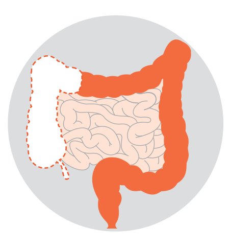 Diagrams showing five types of colectomy: right hemicolectomy, left hemicolectomy, sigmoid colectomy, subtotal or total colectomy and proctocolectomy.