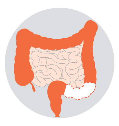 Diagrams showing five types of colectomy: right hemicolectomy, left hemicolectomy, sigmoid colectomy, subtotal or total colectomy and proctocolectomy.