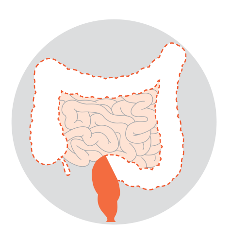 Diagrams showing five types of colectomy: right hemicolectomy, left hemicolectomy, sigmoid colectomy, subtotal or total colectomy and proctocolectomy.