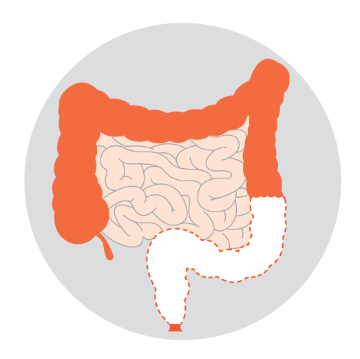Diagrams showing three types of rectal cancer surgeries: High anterior resection, ultra-low anterior resection and abdominoperineal resection.
