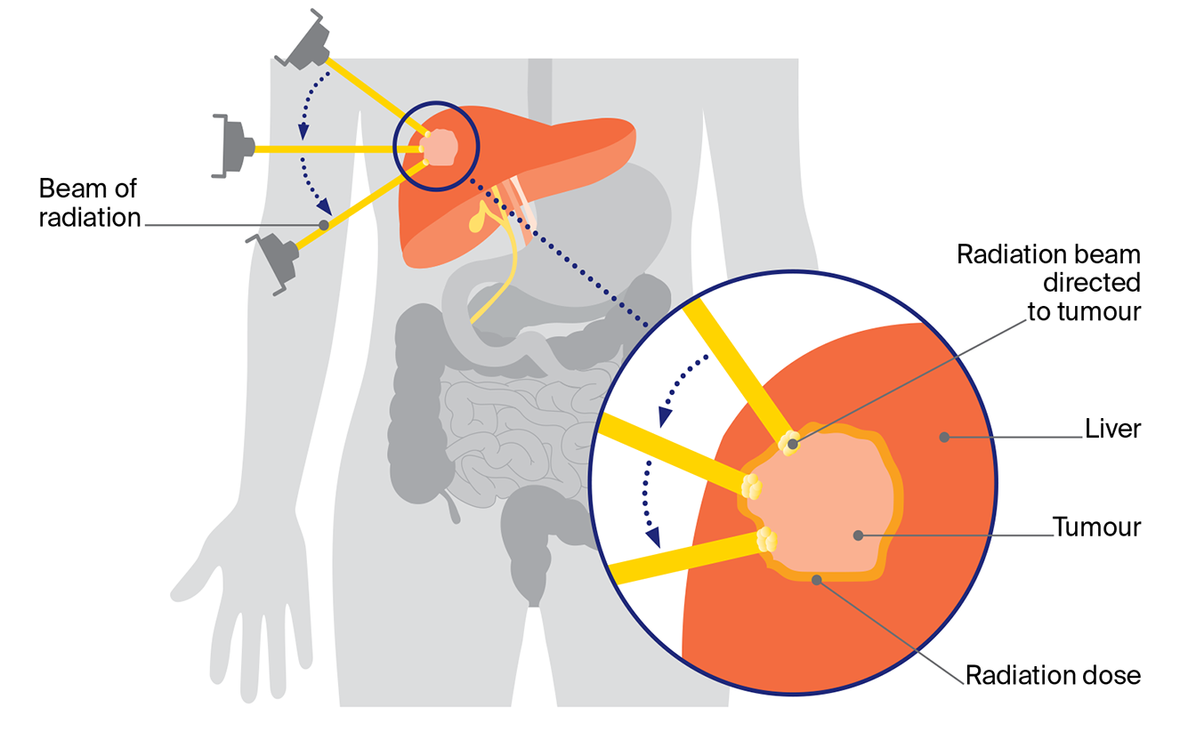 Diagram of stereotactic body radiation therapy (SBRT) showing focused radiation beams aimed at a liver tumour while protecting nearby healthy tissue.