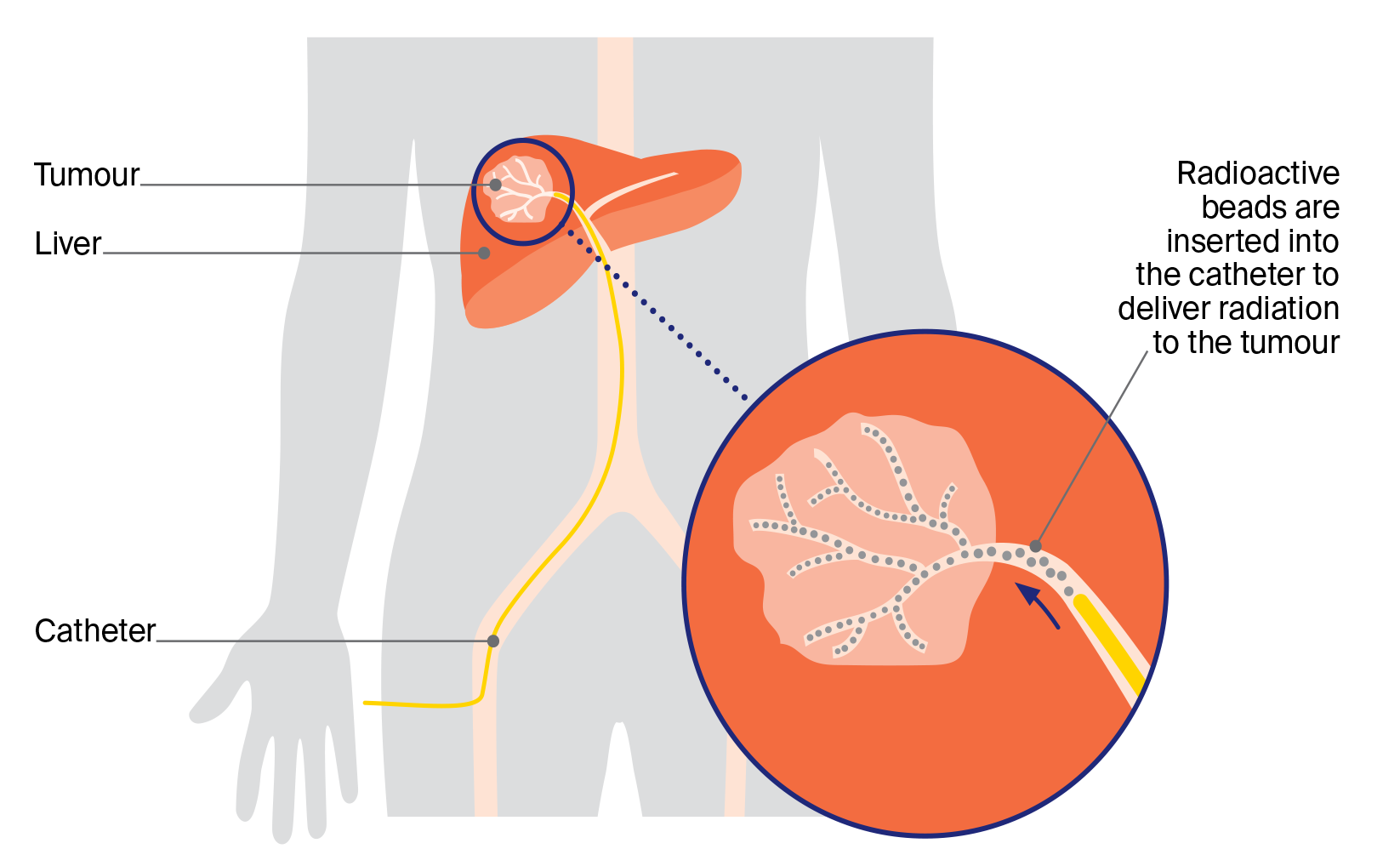 Diagram showing selective internal radiation therapy (SIRT), where a catheter delivers tiny radioactive beads into a liver tumour to treat cancer. 