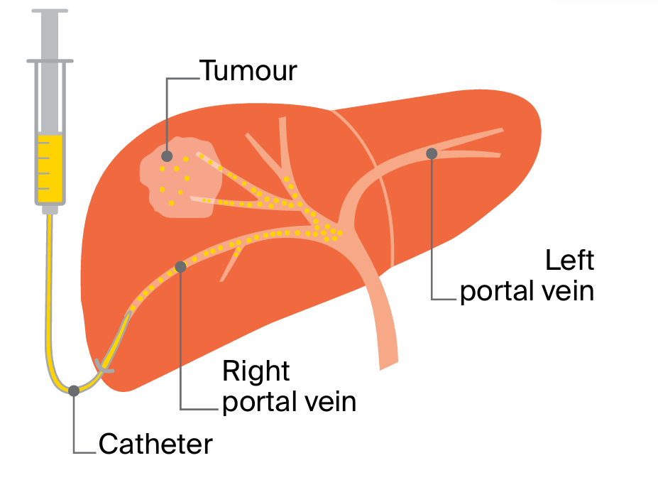 1. The interventional radiologist inserts a tube (catheter) through the skin.
