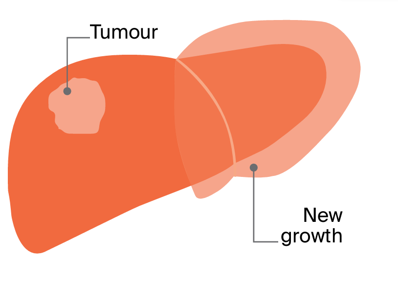 2. Blood is redirected to the part of the liver that will be kept to help it grow