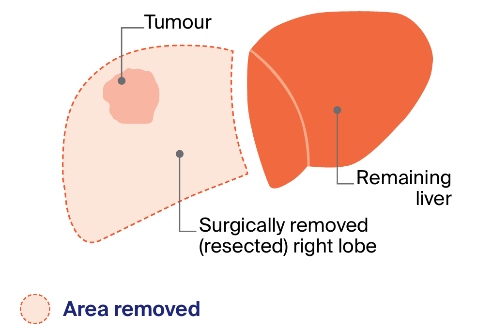 After 4-8 weeks, you will have a CT scan to measure the size of your liver. 