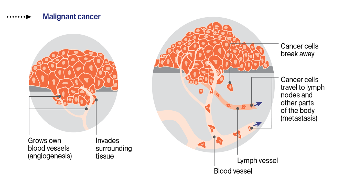 Diagram showing cancer cells breaking away from the tumour, travelling through the blood to the lymph nodes and affecting other organs.