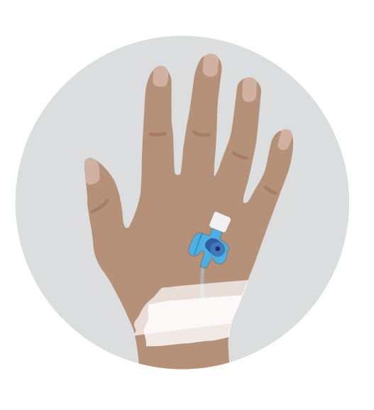 A hand with a small plastic cannula inserted into a vein, secured with tape, used to administer chemotherapy through an IV line.