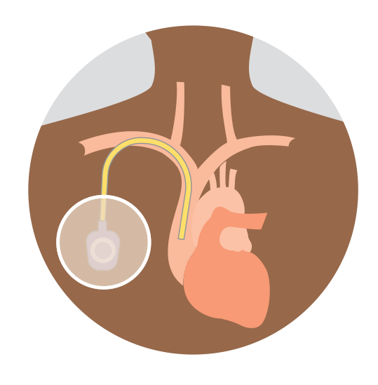 A central venous access device (CVAD) placement in the chest to allow the chemotherapy to be administered into a vein in the chest.