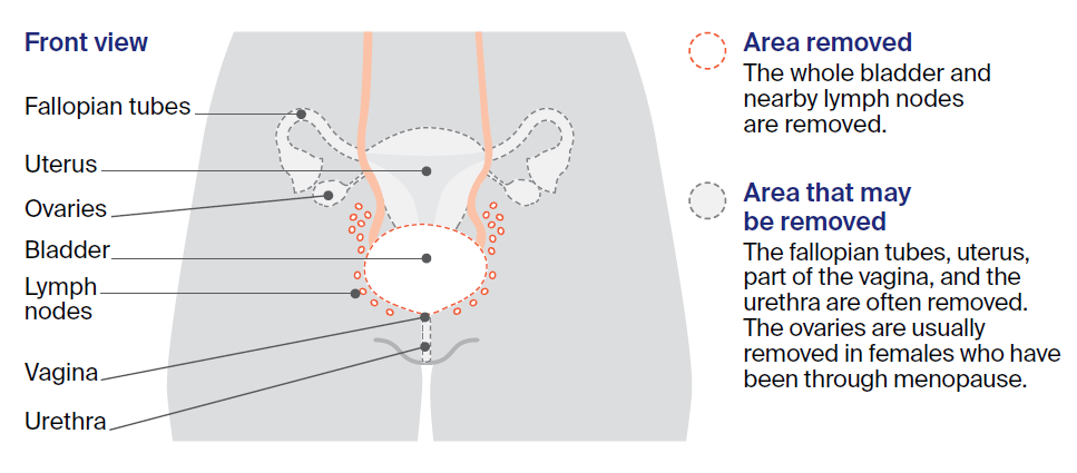 Illustration showing cystectomy in females.
