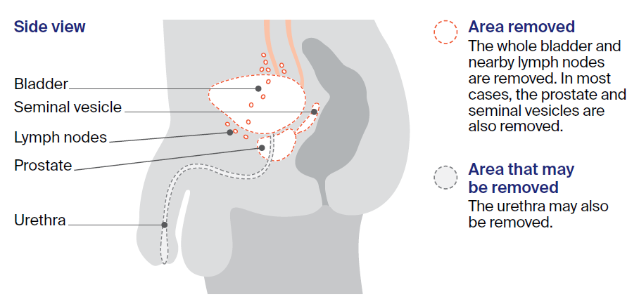 Illustration showing cystectomy in males.