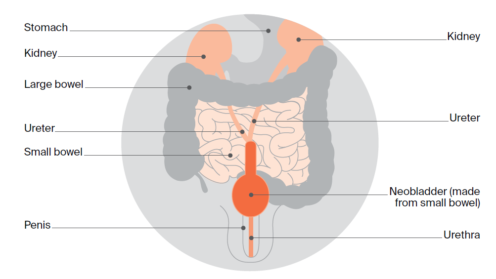 Image of a neobladder. In this method, a pouch is created from a portion of your small bowel and placed in the same area as your original bladder.