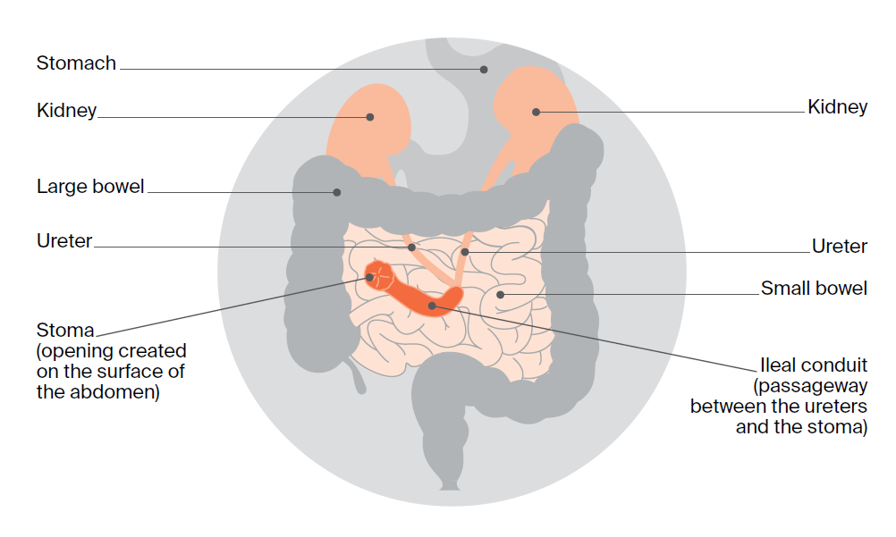 Image of Urostomy. Also known as an ileal conduit, a urostomy is the most common type of urinary diversion. In a urostomy, urine will drain into a bag attached to the outside of the abdomen.