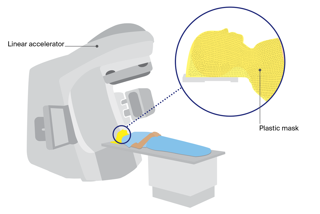 Diagram of brain radiation therapy showing a person wearing a fitted plastic immobilisation mask while a linear accelerator delivers treatment. 