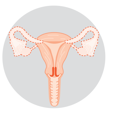 Diagram showing removal of both ovaries and fallopian tubes.
