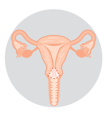 Diagram of a cervix with a cone-shaped section removed.