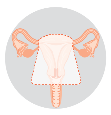 Diagram showing removal of the uterus, cervix and upper vagina.