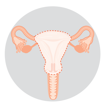 Diagram showing removal of the uterus and cervix.