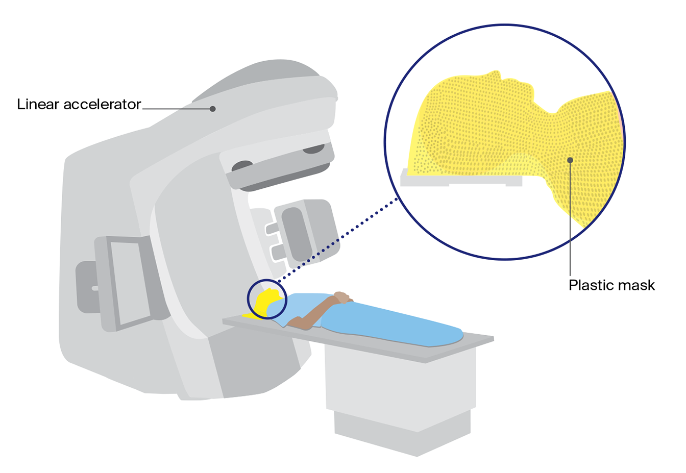 Diagram of external beam radiation therapy showing a linear accelerator delivering radiation while a person lies on a table wearing a plastic mask.