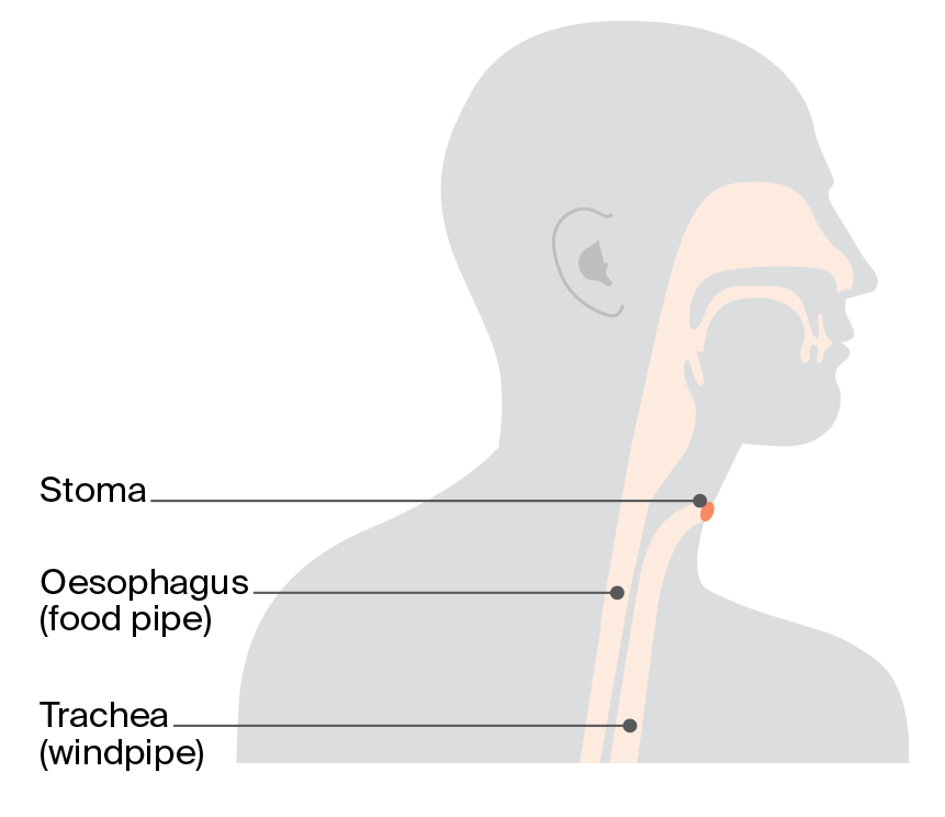 Diagram showing a laryngectomy stoma, a permanent opening in the neck that allows breathing after removal of the larynx, without a tube.