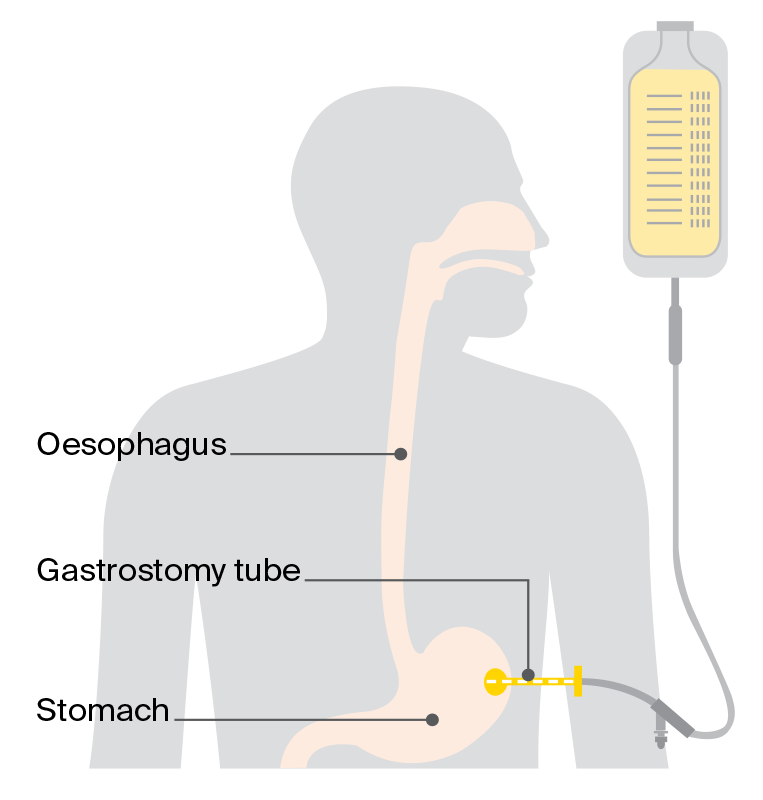 Diagram showing a long‑term feeding tube (gastrostomy) placed through the abdomen into the stomach to provide nutrition over a longer period. 