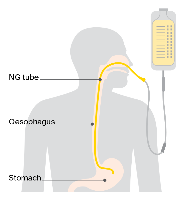 Diagram showing a temporary nasogastric (NG) feeding tube passing through the nose, throat and oesophagus into the stomach to provide liquid nutrition.