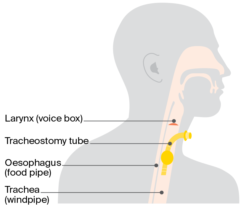 Diagram showing a tracheostomy, where a tube is placed through a hole in the windpipe to create another airway for breathing.