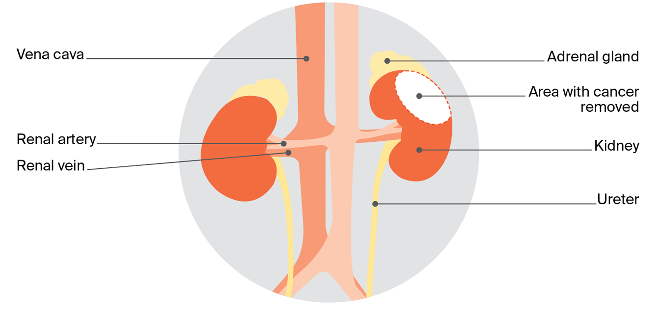 Diagram comparing two kidney surgery types: partial nephrectomy and radical nephrectomy.