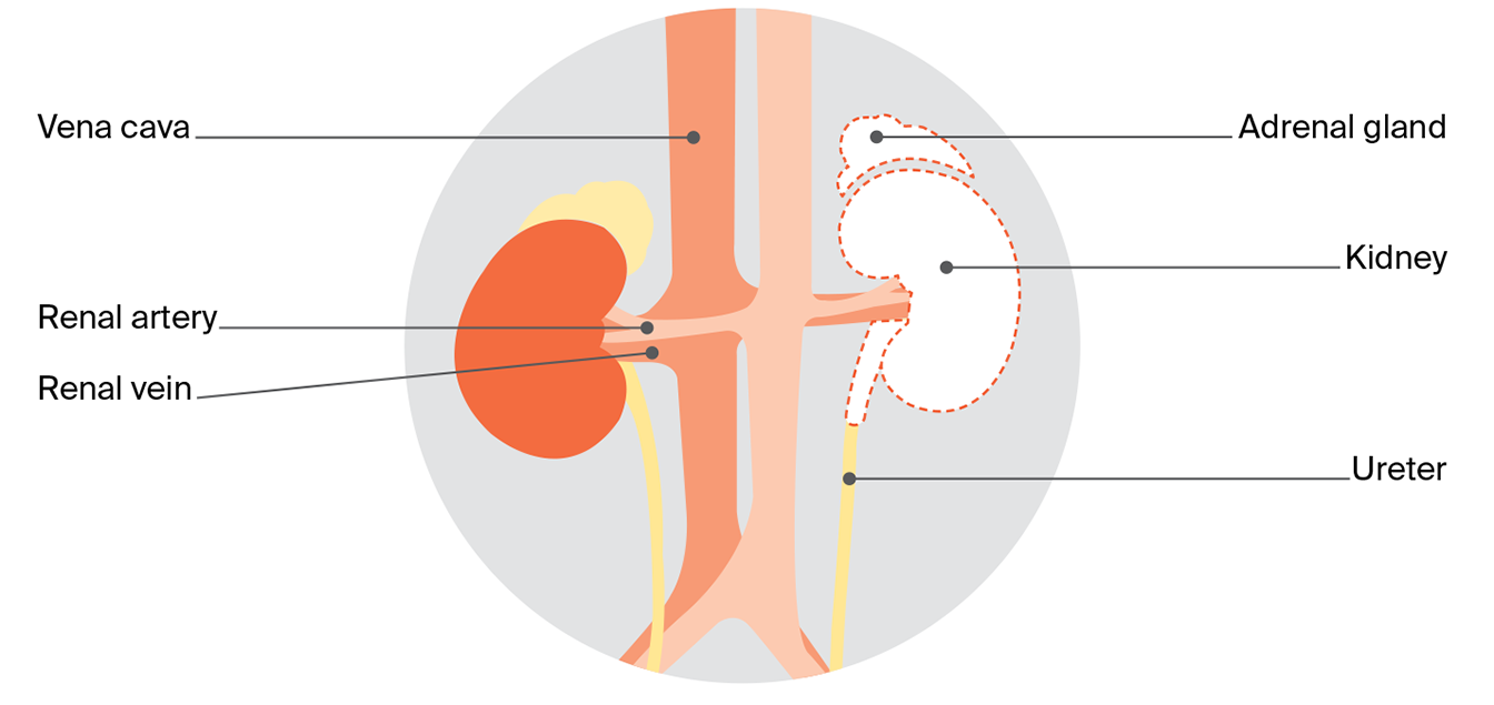 Diagram comparing two kidney surgery types: partial nephrectomy and radical nephrectomy.