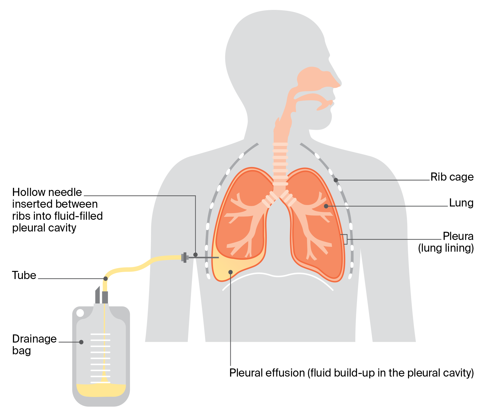 Diagram of a pleural tap showing a hollow needle and tube placed between the ribs to drain fluid from the pleural space into a bag.
