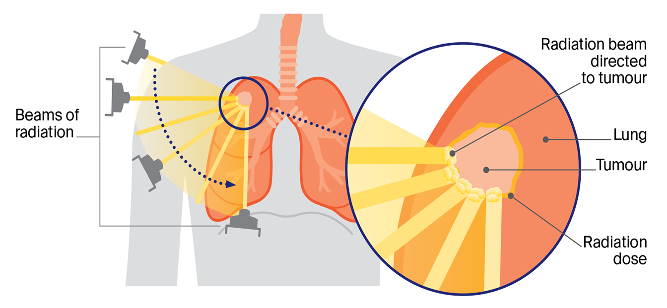 Diagram showing external beam radiation therapy, with a machine sending radiation beams from different angles to target a lung tumour.