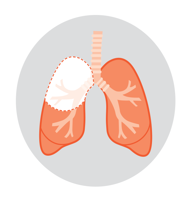 Diagram showing types of lung surgery for lung cancer: lobectomy removes one lobe, pneumonectomy removes a whole lung, and segmentectomy removes a small section.