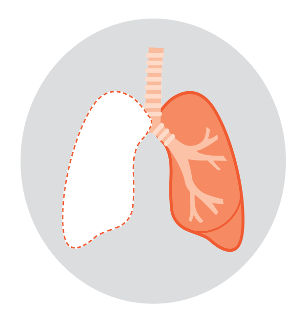 Diagram showing types of lung surgery for lung cancer: lobectomy removes one lobe, pneumonectomy removes a whole lung, and segmentectomy removes a small section.