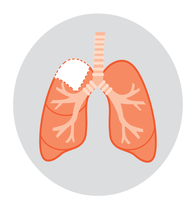 Diagram showing types of lung surgery for lung cancer: lobectomy removes one lobe, pneumonectomy removes a whole lung, and segmentectomy removes a small section.
