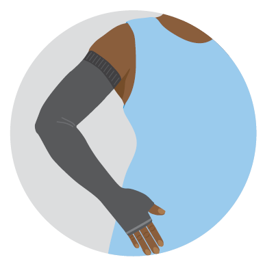 Compression garment worn on an arm and hand to help reduce and control lymphoedema swelling.