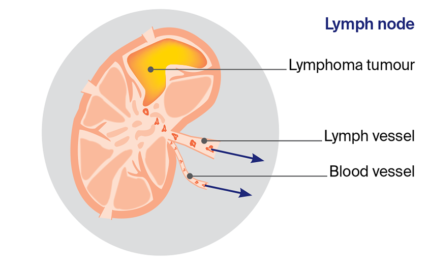 Illustration showing how how lymphoma spreads.