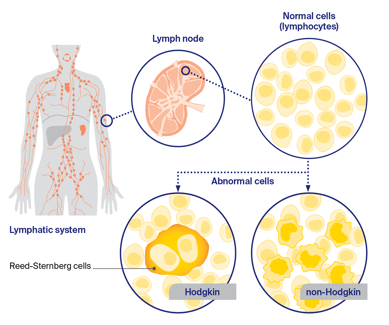 Illustration showing how lymphoma starts