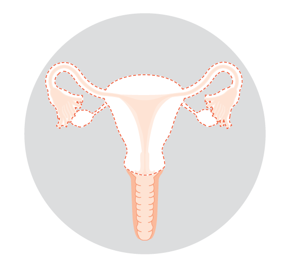 Illustration of a total hysterectomy and bilateral salpingo-oophorectomy
