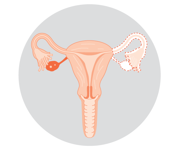 Illustration of a unilateral salpingo-oophorectomy