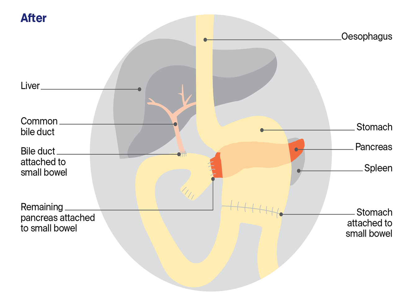 Diagram showing the Whipple procedure after surgery, with the pancreas, bile duct and stomach reconnected to the small bowel for digestion. 