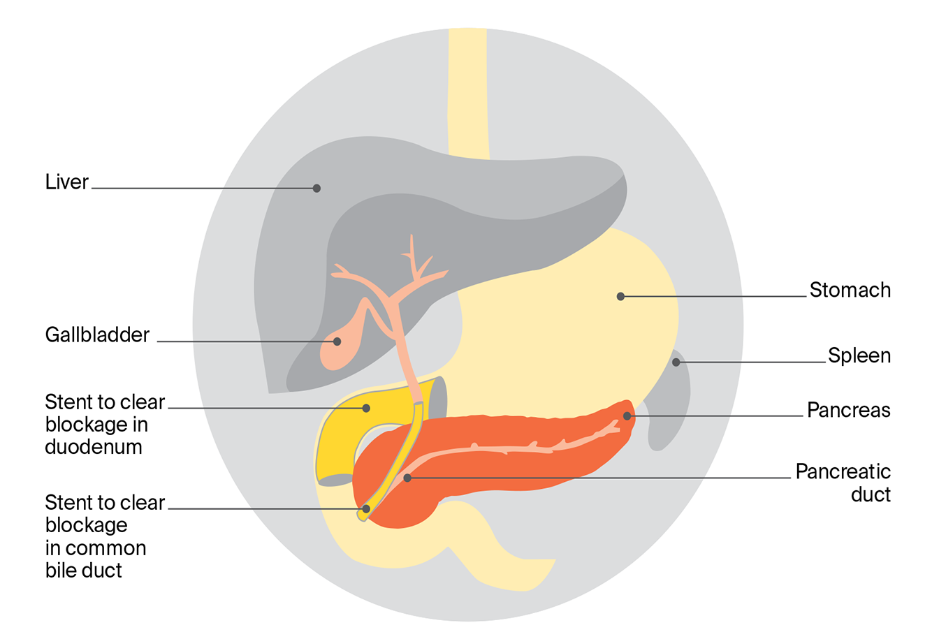 Diagram showing inserting a stent into the bile duct or duodenum to clear a blockage near the pancreas and allow bile or food to flow. 