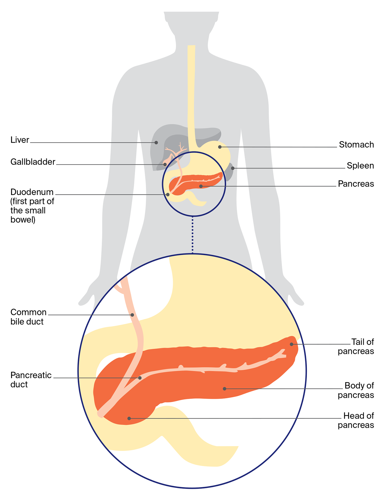 Diagram showing the pancreas in the body, with labels for the head, body and tail of the pancreas, pancreatic duct, bile duct, liver, stomach and duodenum. 