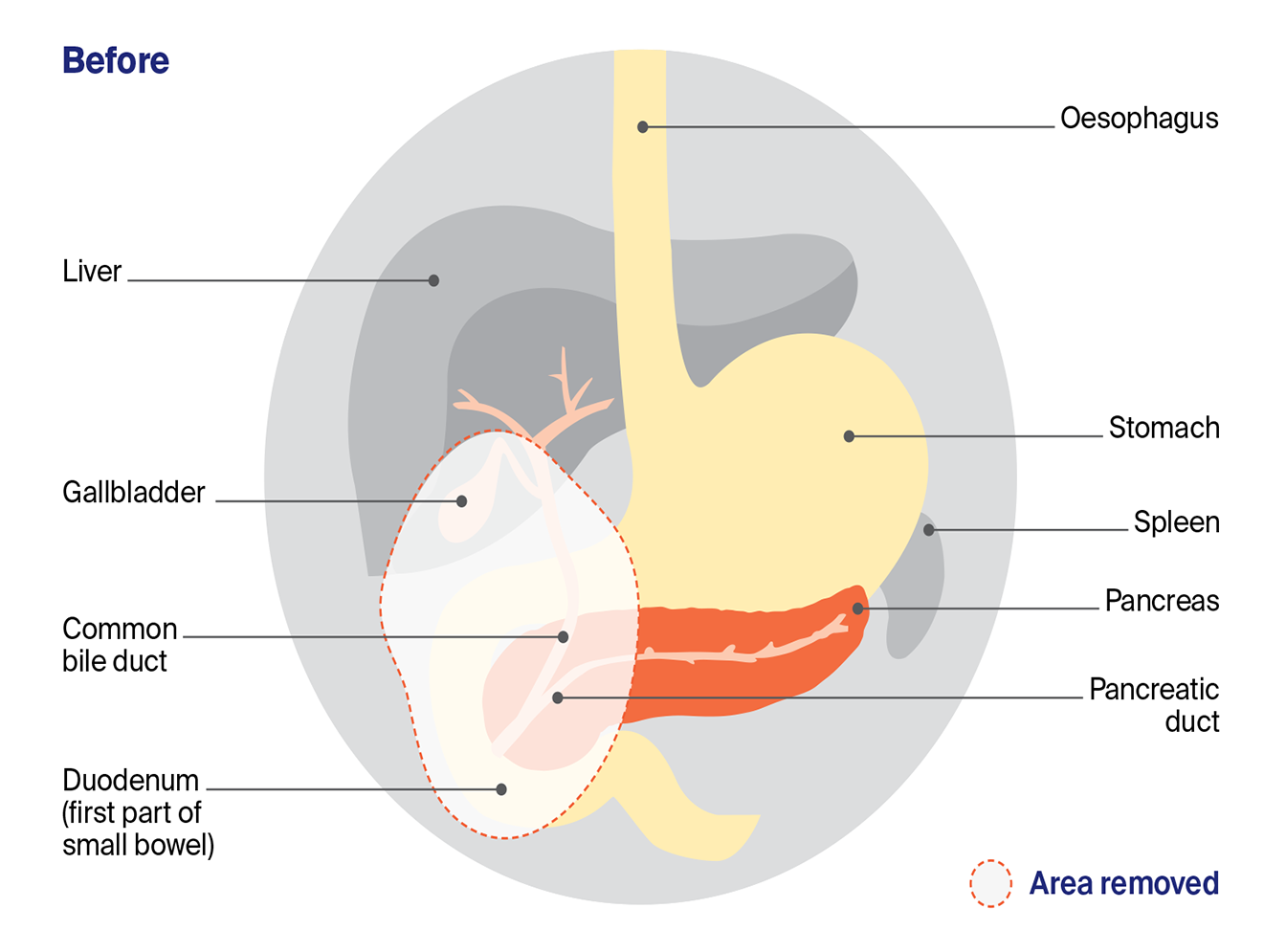 Diagram showing a Whipple procedure, with the area removed outlined, including the head of the pancreas, duodenum, gallbladder and part of the stomach and bile duct.