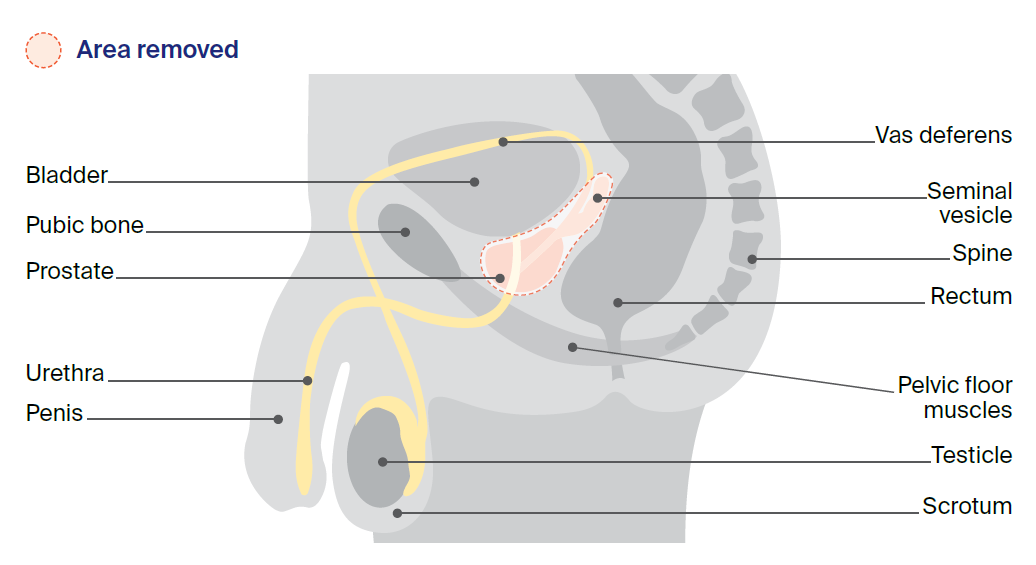 Illustration of a radical prostatectomy to remove the prostate.